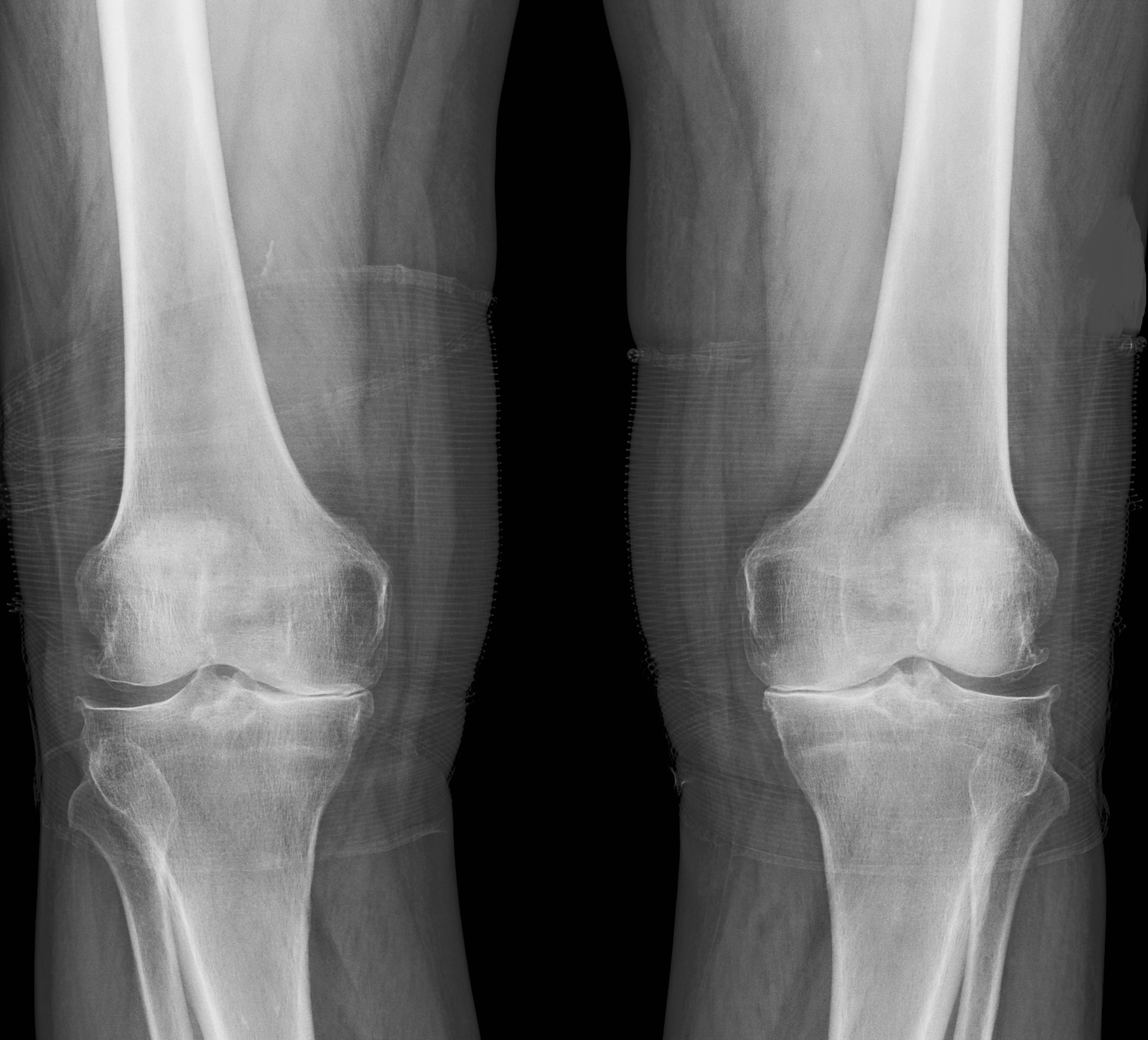 Mennyit ér a szteroid-injekció a térd osteoarthritise esetén?